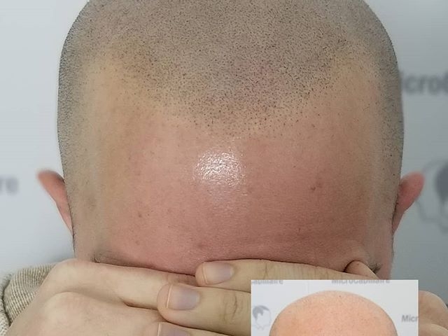 Première session de micropigmentation capillaire