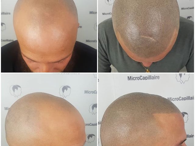 Questions/réponses sur la micropigmentation capillaire