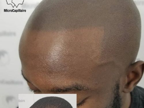 La micropigmentation capillaire peut elle être faite sur des peaux foncées?