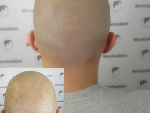 sclap micropigmentation