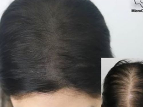 Causes aux pertes de cheveux