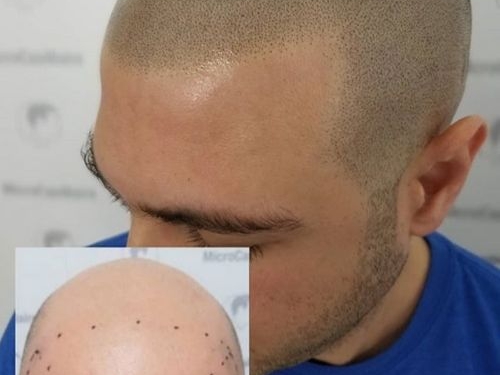 Micropigmentation capillaire et lignes frontales