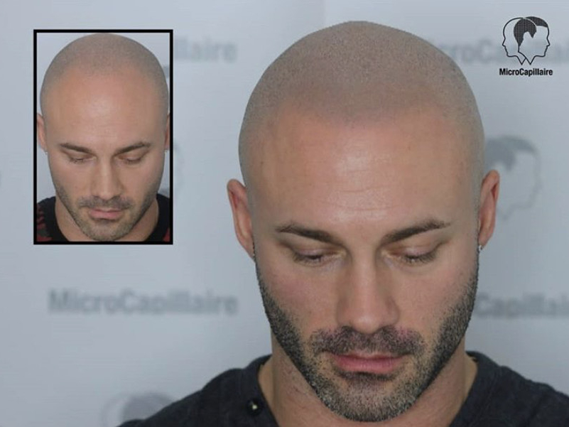 micropigmentation cheveux durée