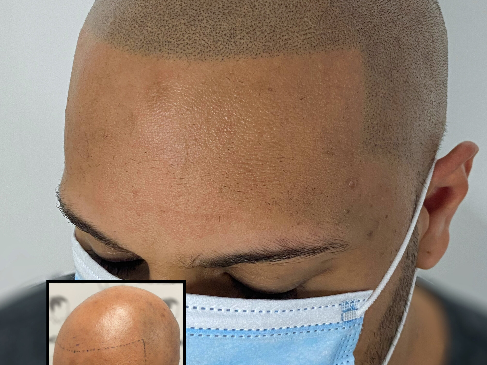 micropigmentation cuir chevelu