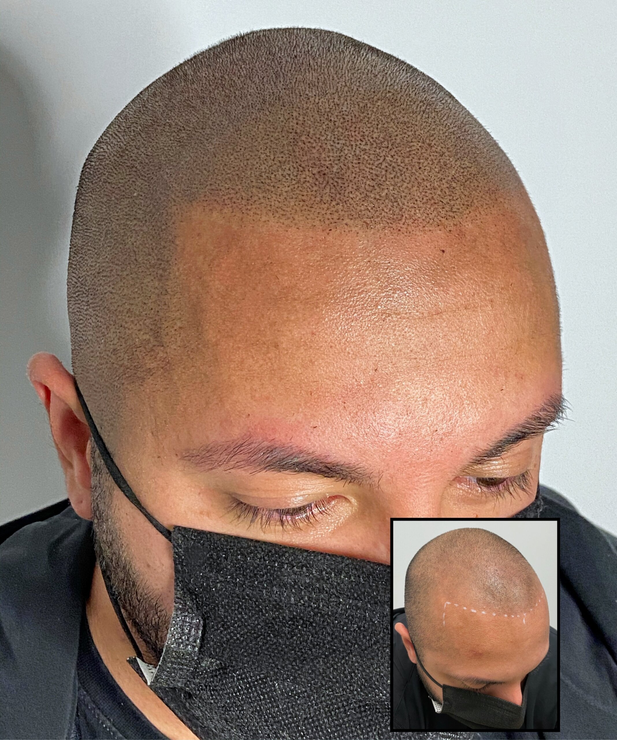 Scalp Micropigmentation in Montreal - Hair Loss Solution - MicroCapillaire