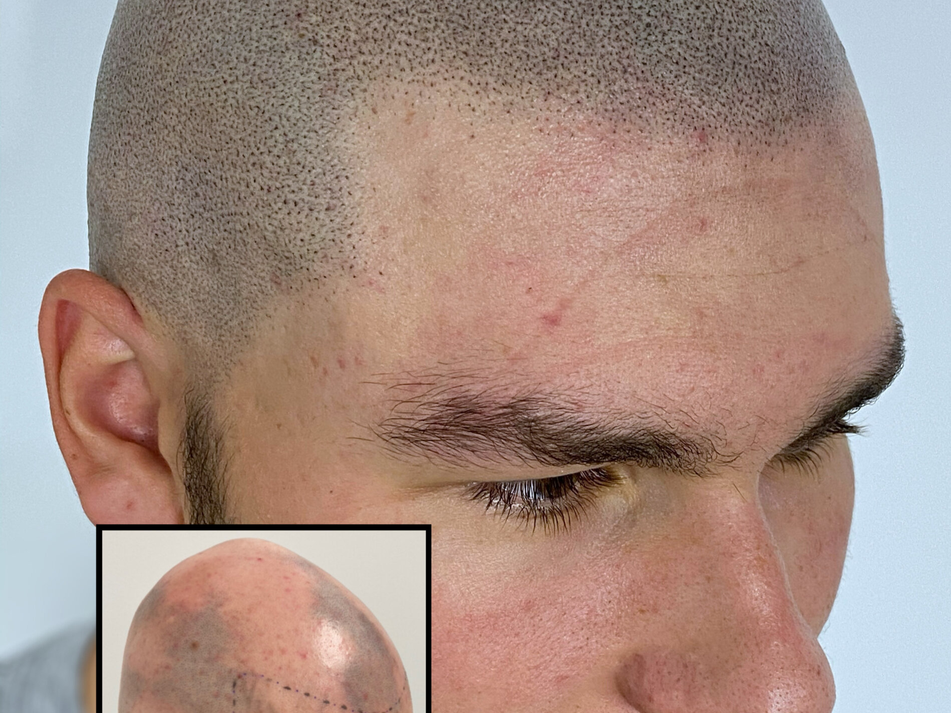 micropigmentation cheveux tarif