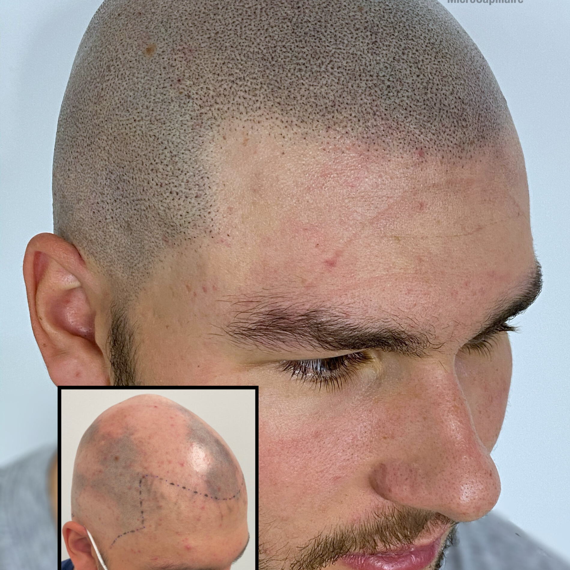 micropigmentation cheveux tarif