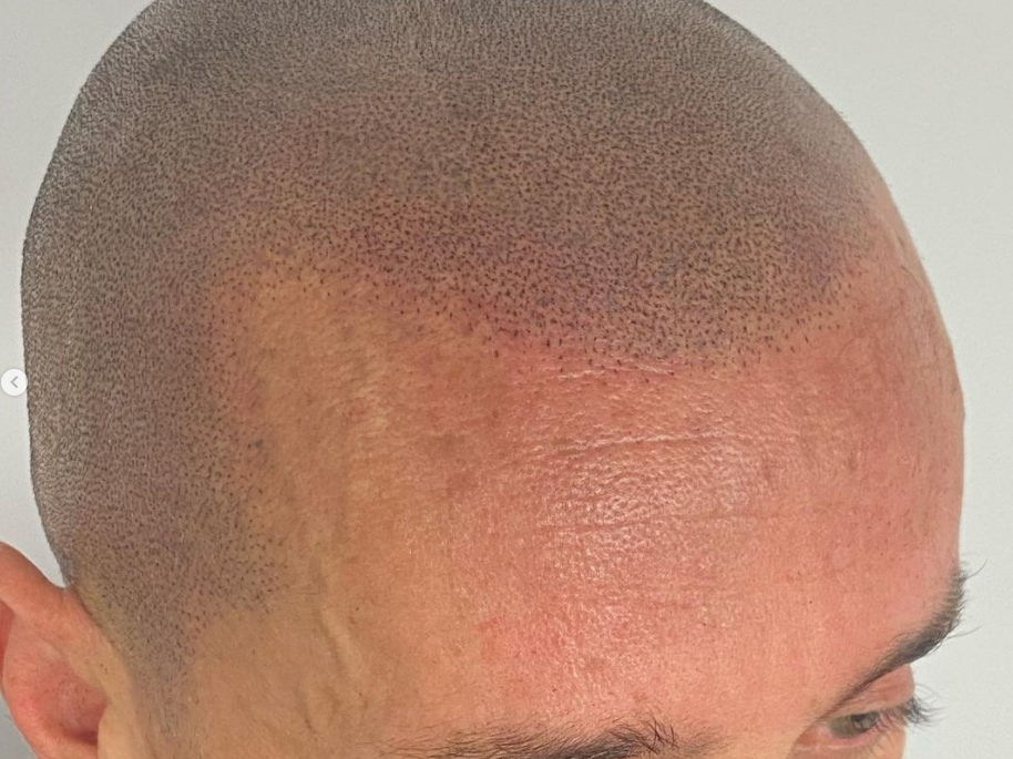 micropigmentation cheveux homme