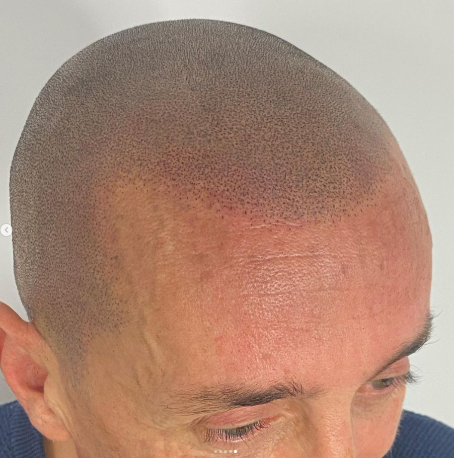 micropigmentation cheveux homme