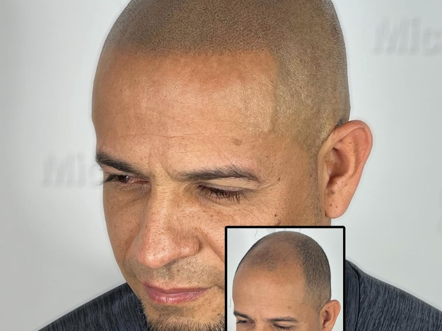 Dermopigmentation