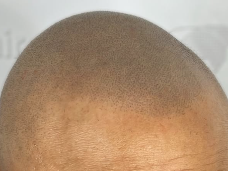 Les bons traitements de micropigmentation capillaire