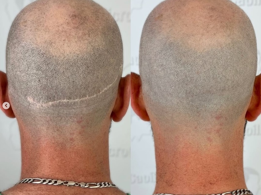 La micropigmentation pour dissimuler une cicatrice de greffe