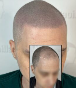 Consultation en micropigmentation : Ce que l’on ne vous dit pas (et comment éviter les pièges)