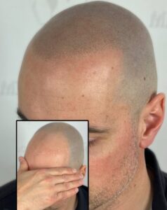 Consultation en micropigmentation : Ce que l’on ne vous dit pas (et comment éviter les pièges)