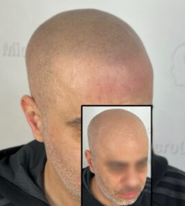 Consultation en micropigmentation : Ce que l’on ne vous dit pas (et comment éviter les pièges)