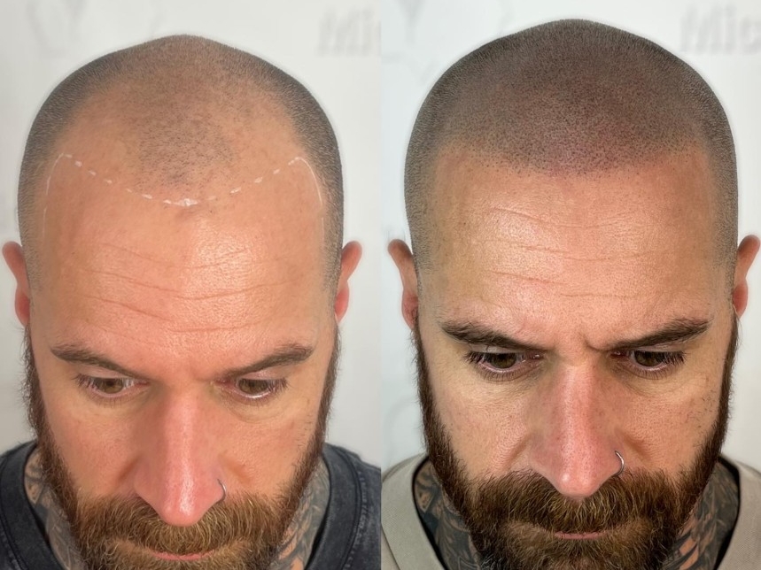 La micropigmentation capillaire abîme-t-elle les cheveux existants ?