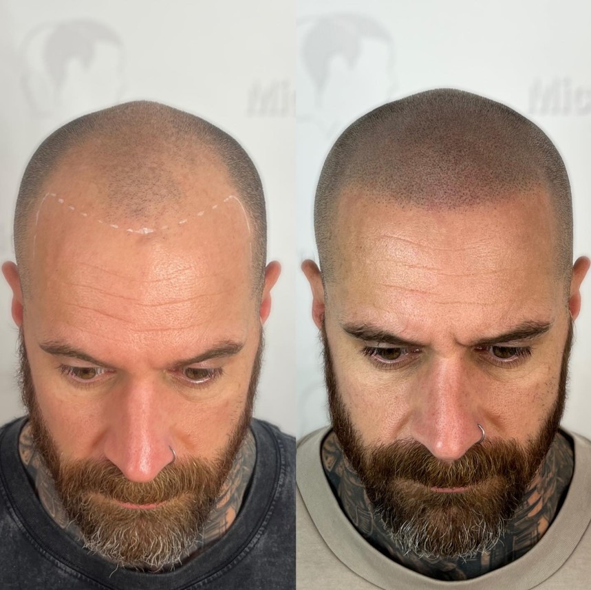 La micropigmentation capillaire abîme-t-elle les cheveux existants ?
