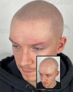 La micropigmentation capillaire abîme-t-elle les cheveux existants ?
