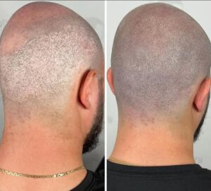 La micropigmentation capillaire abîme-t-elle les cheveux existants ?