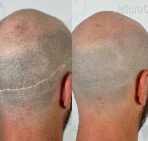 Micropigmentation vs Tatouage traditionnel : Quelle est la vraie différence ?