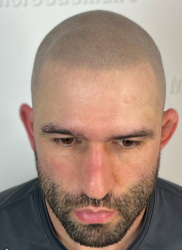 Micropigmentation vs Tatouage traditionnel : Quelle est la vraie différence ?