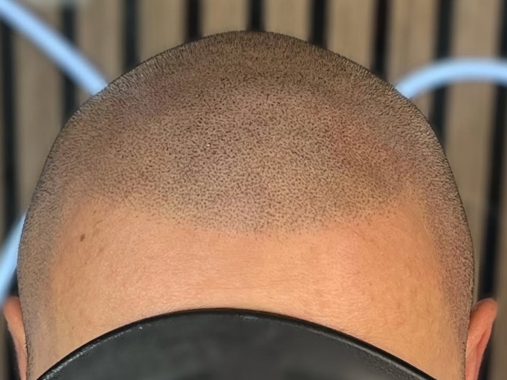 Le guide ultime de la micropigmentation capillaire : Réponses à vos questions fréquentes