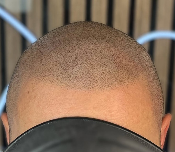 Le guide ultime de la micropigmentation capillaire : Réponses à vos questions fréquentes