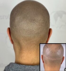 Le guide ultime de la micropigmentation capillaire : Réponses à vos questions fréquentes