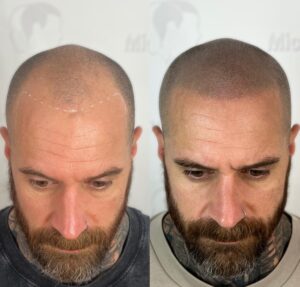 Le guide ultime de la micropigmentation capillaire : Réponses à vos questions fréquentes