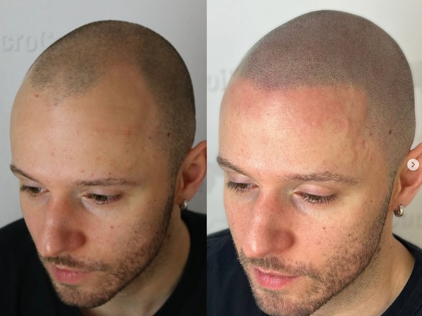 La micropigmentation nuit-elle à une future greffe capillaire ?