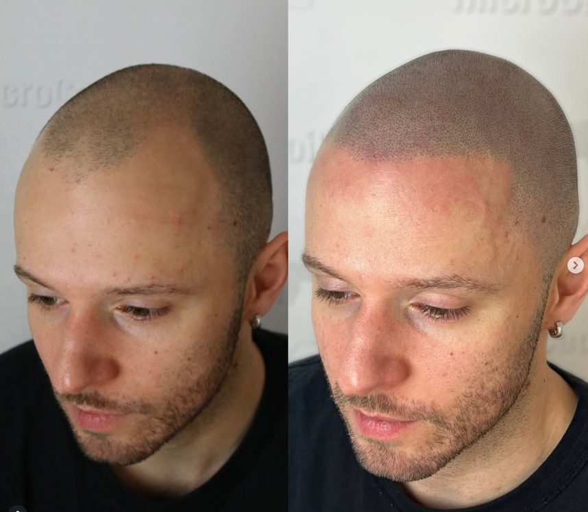 La micropigmentation nuit-elle à une future greffe capillaire ?