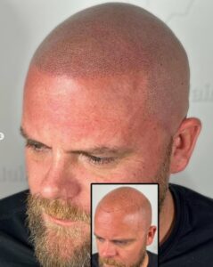 La micropigmentation nuit-elle à une future greffe capillaire ?