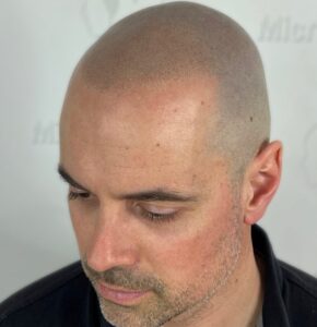 La micropigmentation nuit-elle à une future greffe capillaire ?