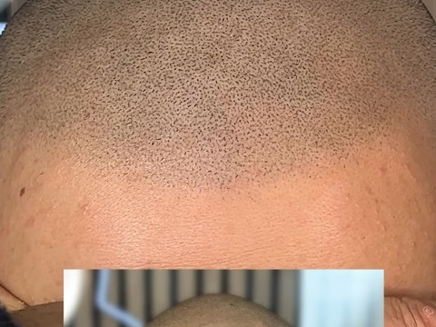 Contre-indications de la micropigmentation du cuir chevelu : Êtes-vous éligible ?