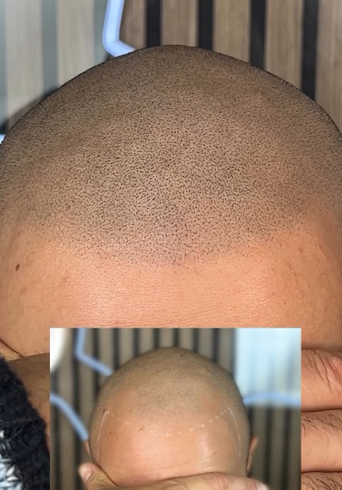 Contre-indications de la micropigmentation du cuir chevelu : Êtes-vous éligible ?