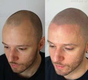 Contre-indications de la micropigmentation du cuir chevelu : Êtes-vous éligible ?