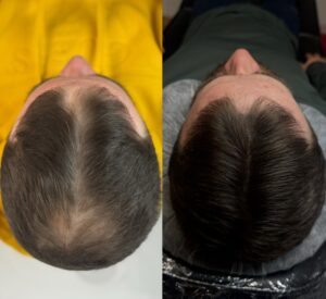 Quel est le prix d'une micropigmentation capillaire ?