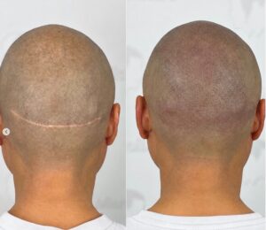 Quel est le prix d'une micropigmentation capillaire ?