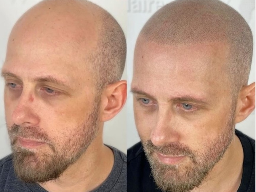 Quel est le prix d'une micropigmentation capillaire ?