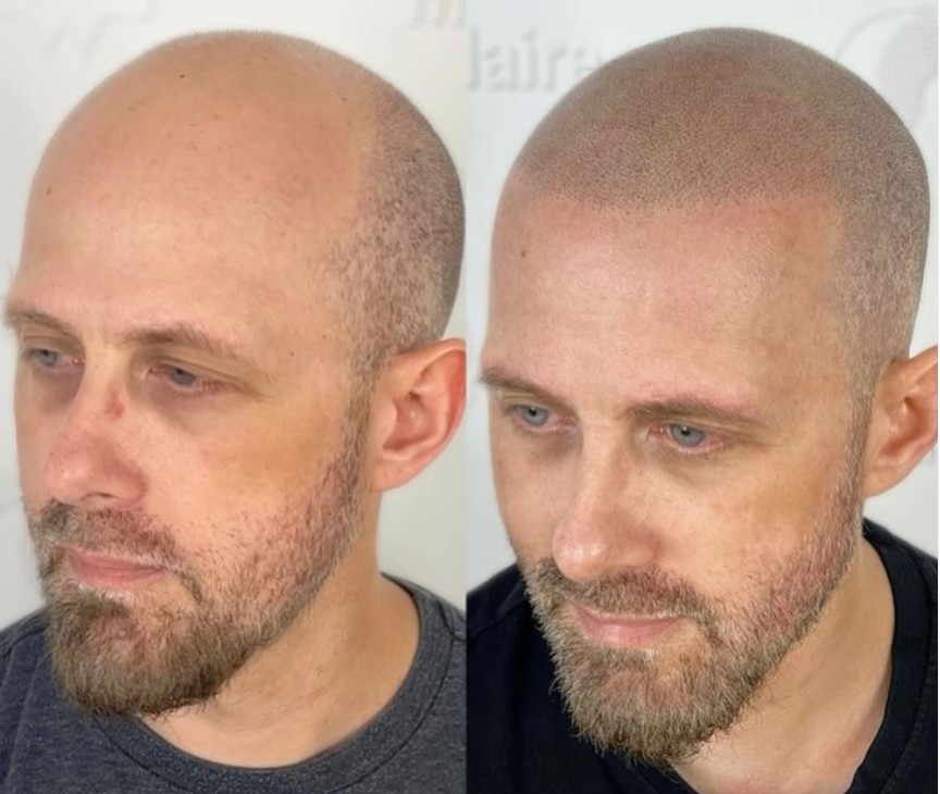 Quel est le prix d'une micropigmentation capillaire ?